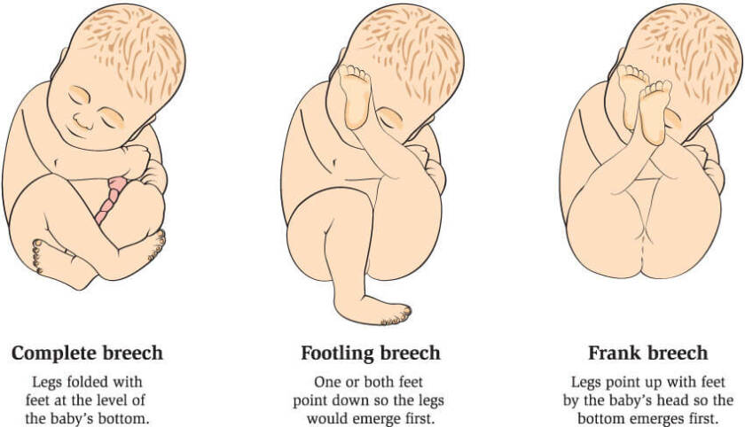 Breech Baby - This baby is not for turning! - All About Birth